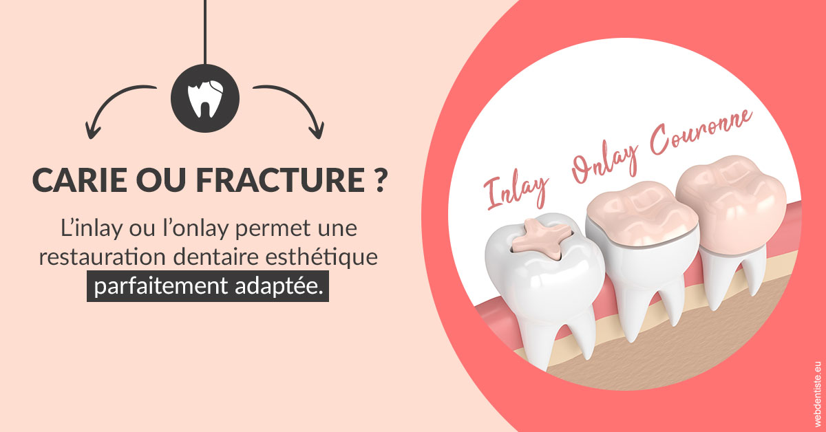 https://dr-becker-michel.chirurgiens-dentistes.fr/T2 2023 - Carie ou fracture 2