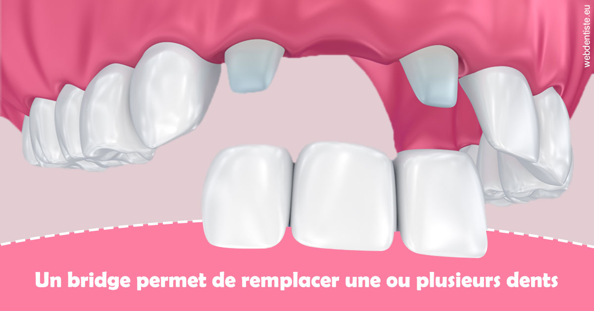 https://dr-becker-michel.chirurgiens-dentistes.fr/Bridge remplacer dents 2