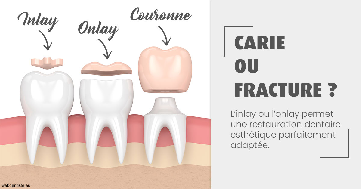 https://dr-becker-michel.chirurgiens-dentistes.fr/T2 2023 - Carie ou fracture 1