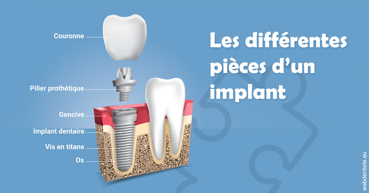 https://dr-becker-michel.chirurgiens-dentistes.fr/Les différentes pièces d’un implant 1